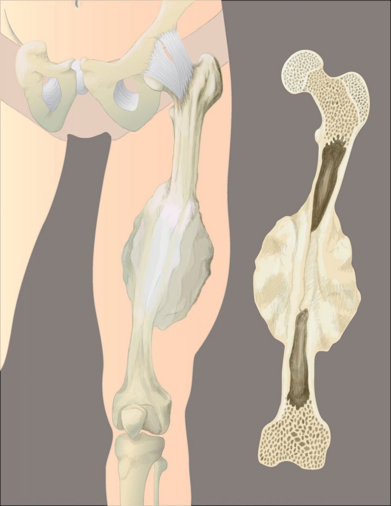 O que é osteossarcoma?