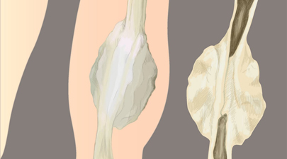 O que é osteossarcoma?