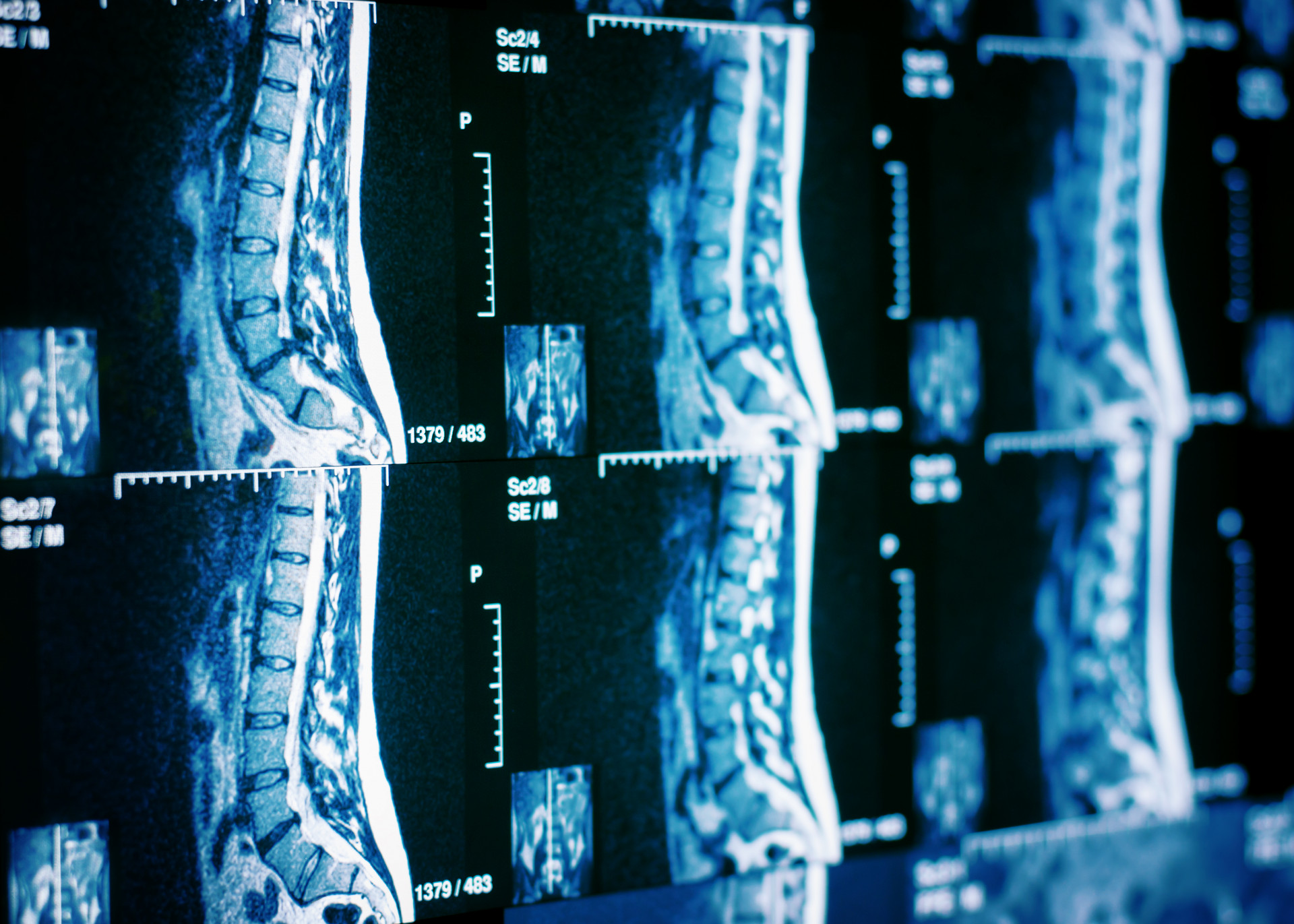 Cirurgia na Coluna