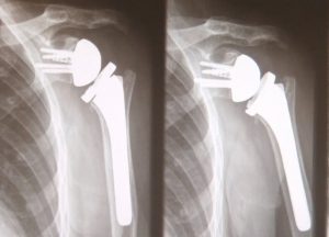 Cirurgia no Ombro